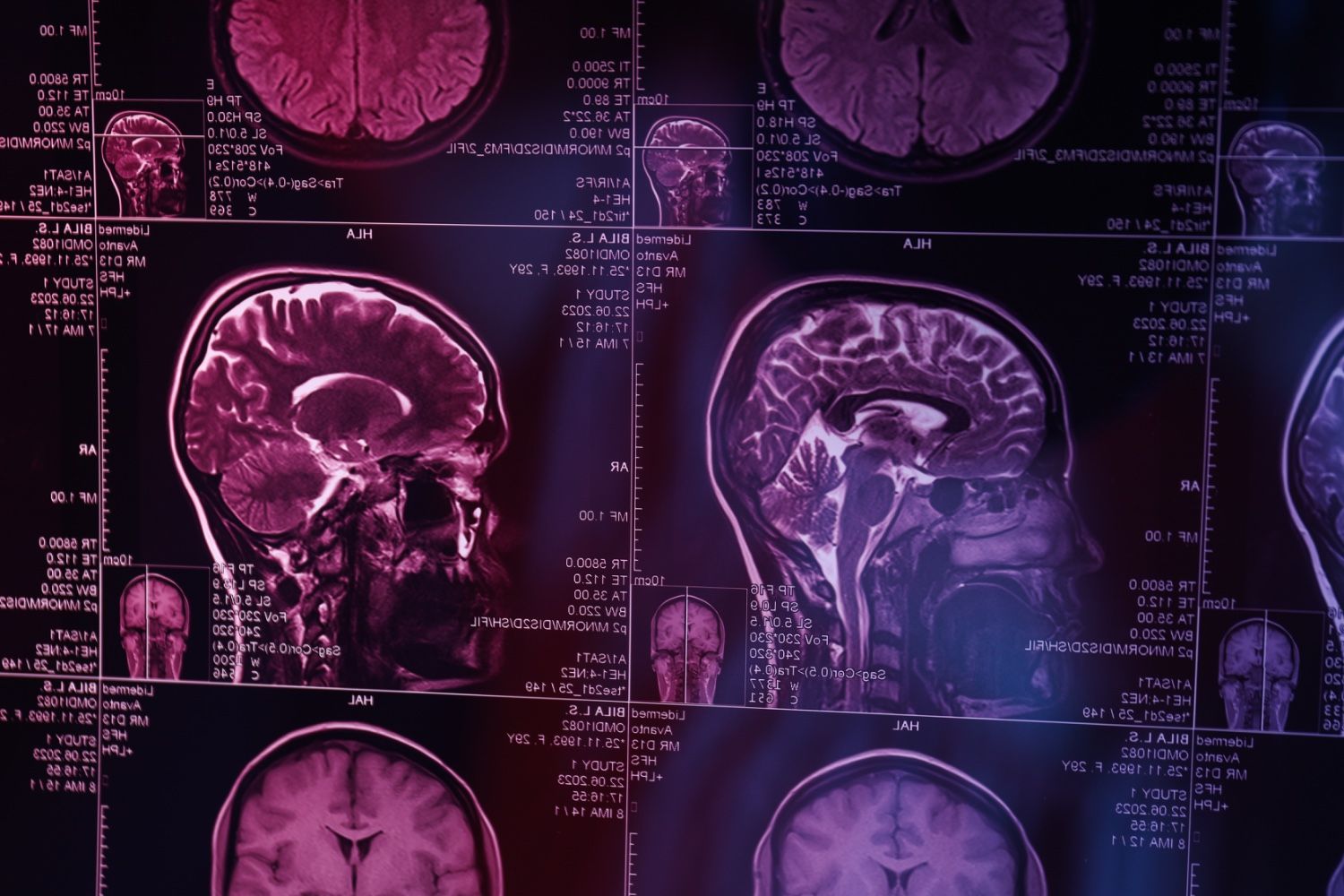 Sinir Sistemi Hastalıkları