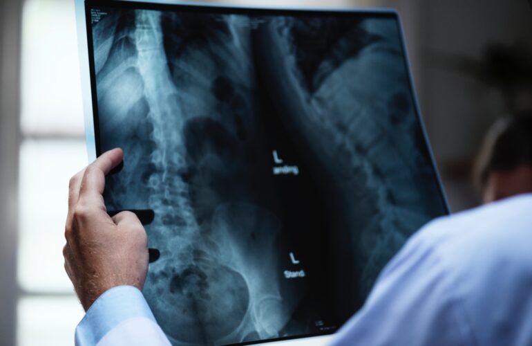 Kuyruk Sokumu Kırığı Belirtileri, Tedavisi ve Ne Zaman İyileşir?